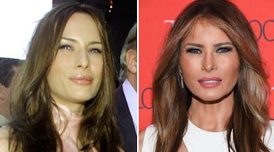 Melania Trump and cosmetic surgery, has she retouched herself or not?