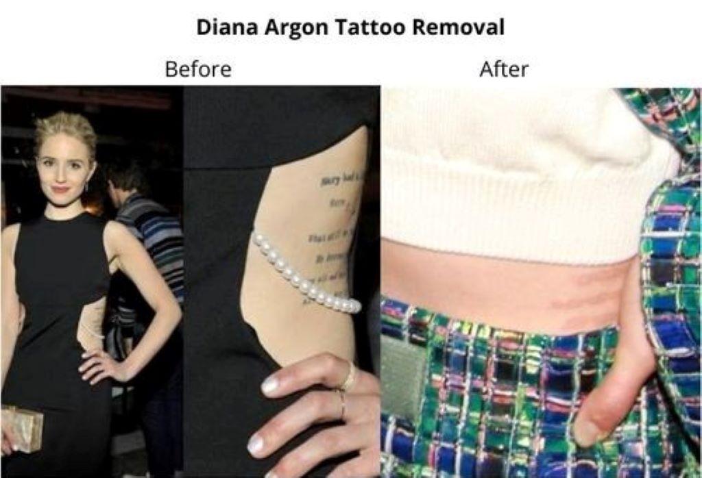 Did Diana Agron Remove Her Wonderland Tattoo? Before and after pictures - Did Diana Agron Remove Her Wonderland Tattoo Before and after